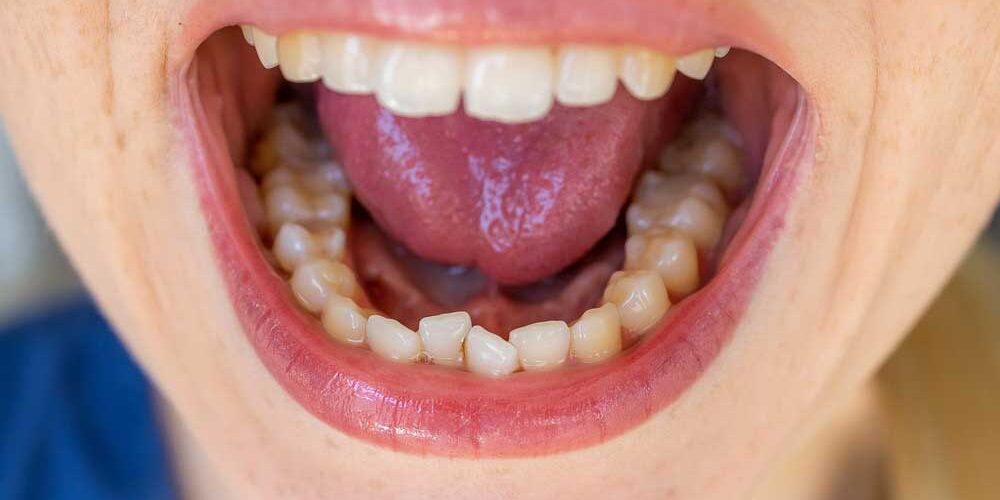 fogkő eltávolítás