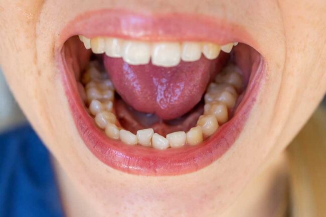 fogkő eltávolítás